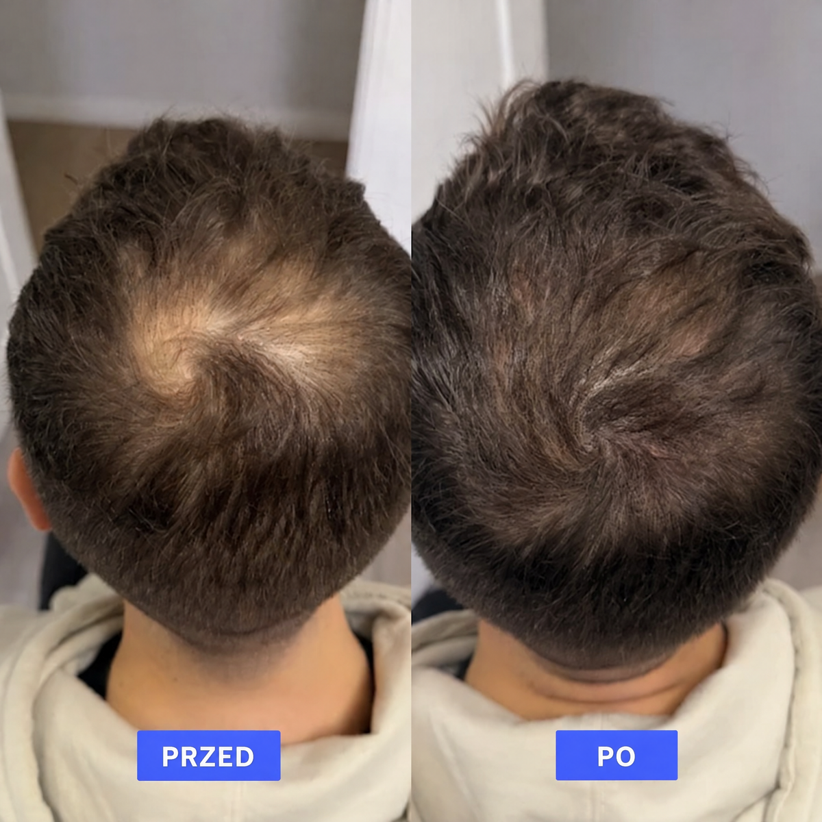 puder-swk-przed-po
